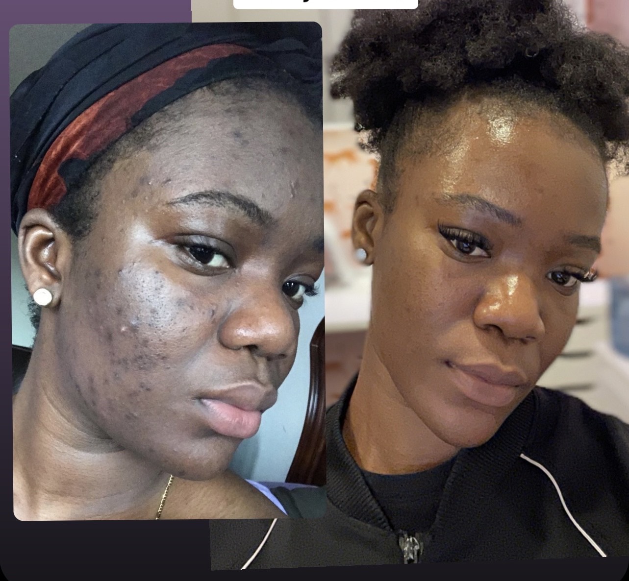 Best Chemical Peel for Hyperpigmentation to Achieve Radiant Skin