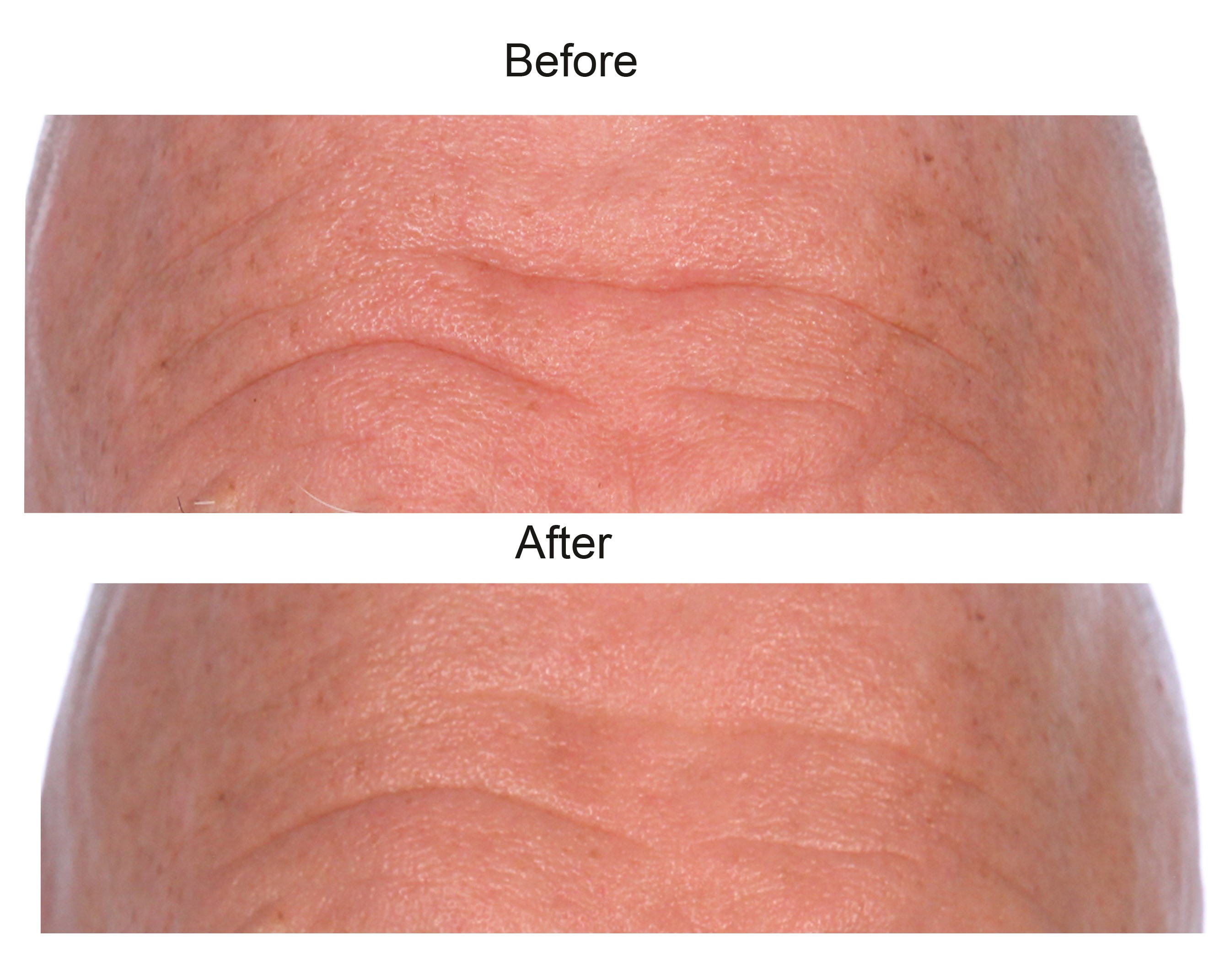 How to Hide Forehead Wrinkles - 5 Tips that Work How to Hide Forehead Wrinkles - 5 Tips that Work