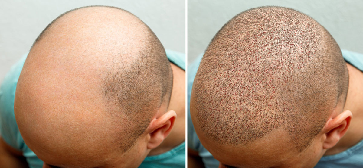 Best hair transplant in the us is the best option for those in need of a permanent solution to hair loss.