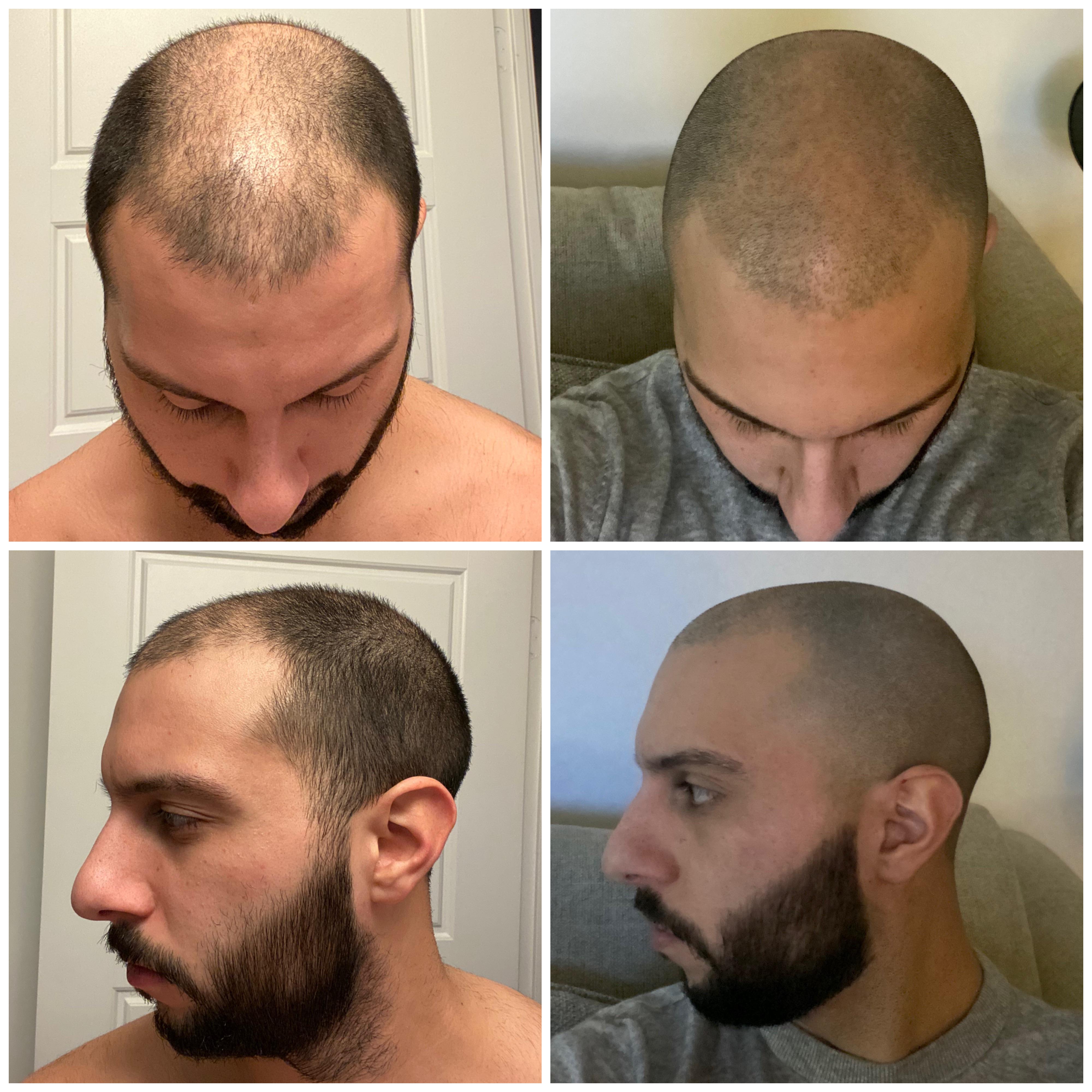 Best Haircut for Balding Men Best Haircut for Balding Men