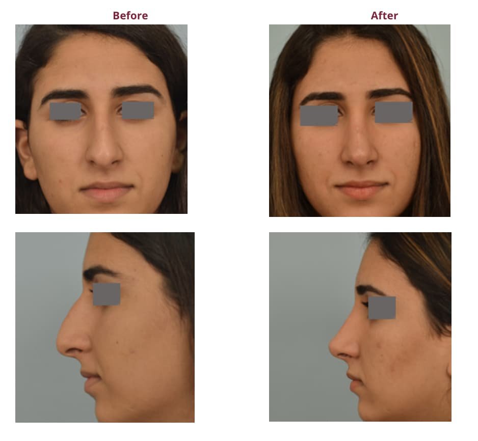 The Best Rhinoplasty Surgeons in Los Angeles - My Beauty Consultant The Best Rhinoplasty Surgeons in Los Angeles - My Beauty Consultant