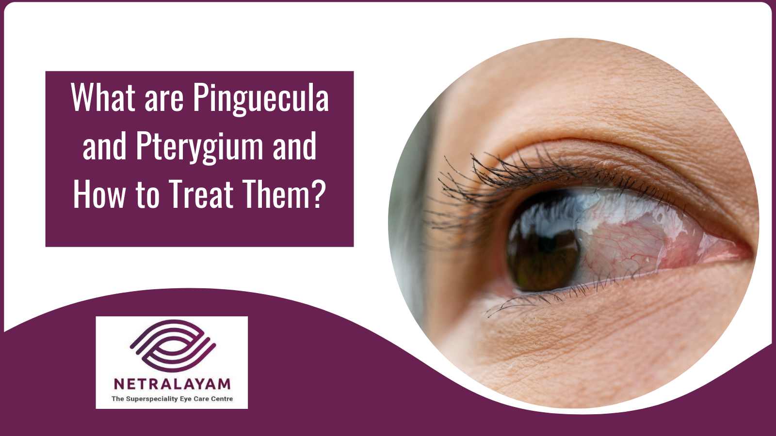 What best eye drop for pterygium can do for you effectively?